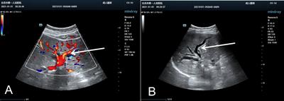 Perihilar cholangiocarcinoma masquerading as intrahepatic cholestasis of pregnancy: a case report and review of the literature